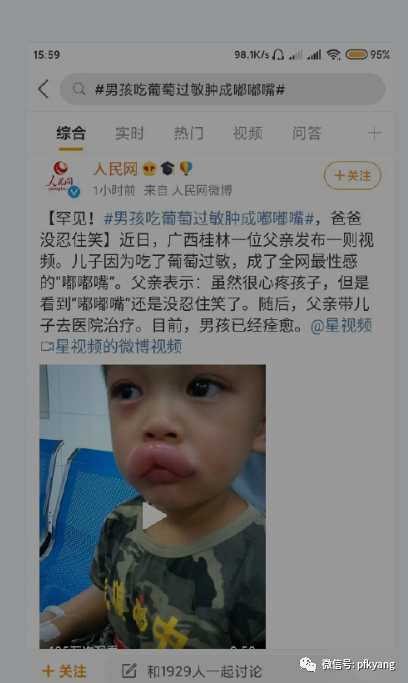 男孩吃葡萄過敏腫成嘟嘟嘴怎么回事？畫面詳情曝光網(wǎng)友忍不住笑了(圖3)